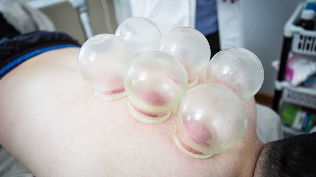 Arron Chan performing cupping on a clients back